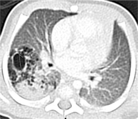 Ct Scan Of The Chest Showing Multiple Variable Sized Cysts In The Right