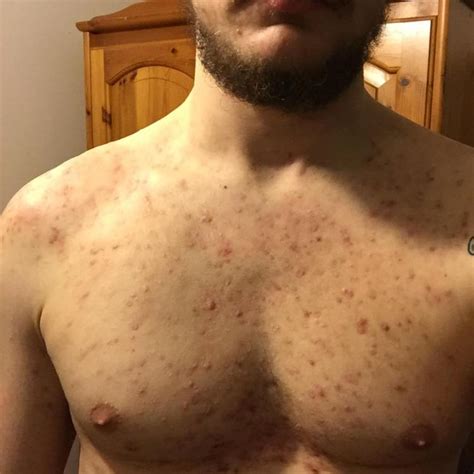 Bad Body Scars From Acne Please Help Scar Treatments