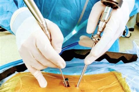 First Dualportal Endscopic Spine Procedure Performed Spinal News