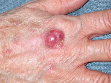 Merkel Cell Carcinoma Critical Review With Guidelines For