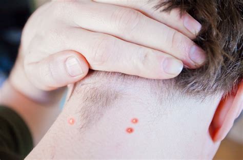 Acne Or Pimples On Back Of Neck Learn Causes And Treatment