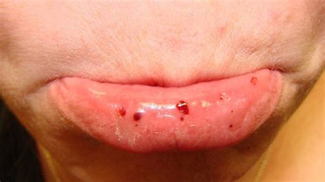 Purple Spot On Inside Of Lip