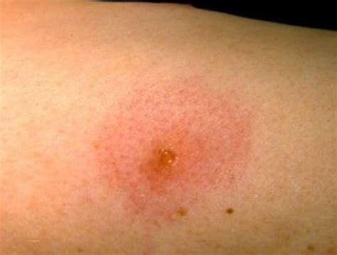 Ingrown Hair Vs Bed Bug Bite