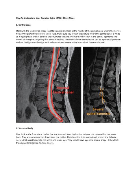 Spine Mri Imaging How To Understand Your Complex Spine Mri In 8