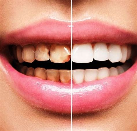 Brush your teeth as you normally would for 2 minutes with soft, circular motions. Does baking soda really help whiten teeth? - Quora