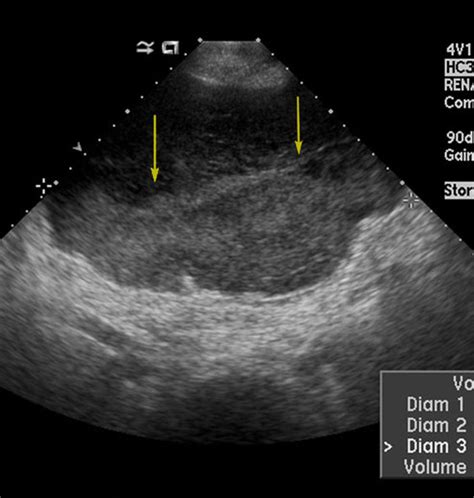 Pelvic Ultrasound Anatomy