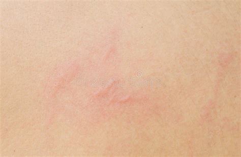 Rash On The Skin Stock Photo Image Of Dermatology Allergies 125715684