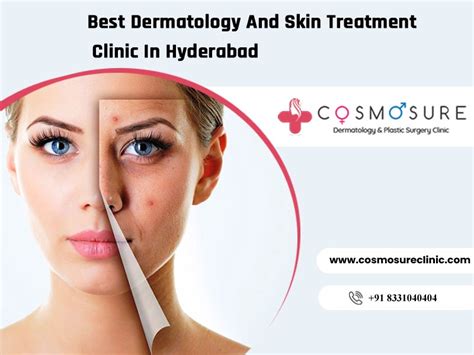 Best Dermatology And Skin Treatment Clinic In Hyderabad Cosmosure Clinic