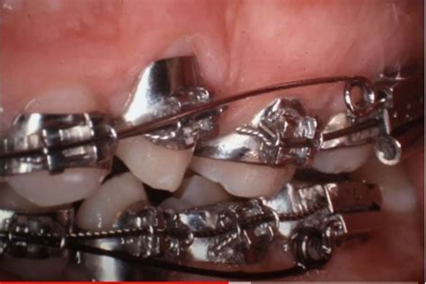 1980s Braces Full Bands Dental Braces Metal Braces Orthodontics Braces