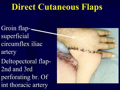 Wound Coverage Techniques Flaps OrthopaedicPrinciples Com