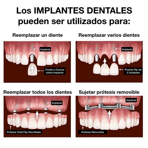Los Implantes Dentales Santa In S Cl Nica Odontol Gica