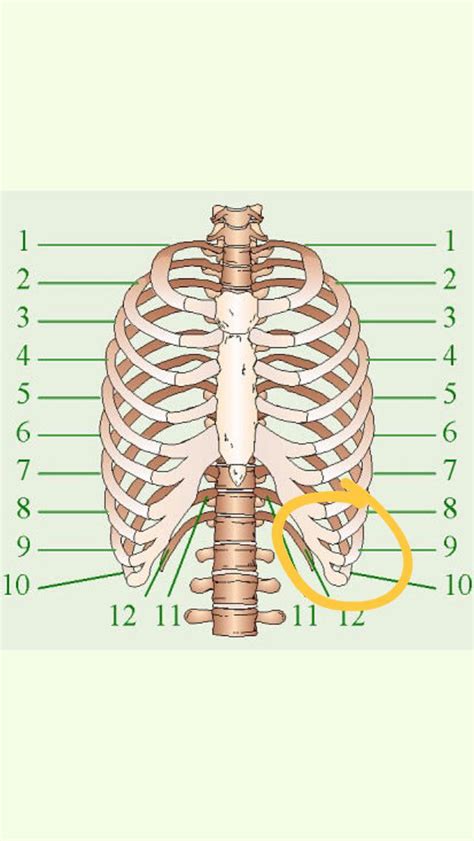 Anyone Have Lumps On This Parts Of The Ribs Rcostochondritis