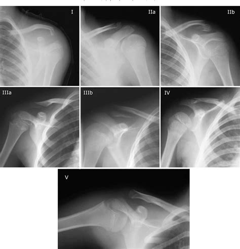 Figure 1 From Outcome Of Distal Clavicular Fracture Separations And