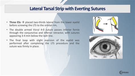 A Comparison Of The Lateral Tarsal Strip With Everting Sutures And The