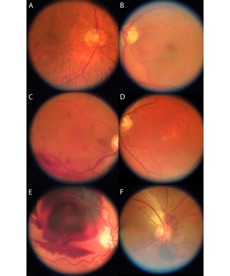 Exemplary Smartphone Based Fundus Images Of The Posterior Pole A