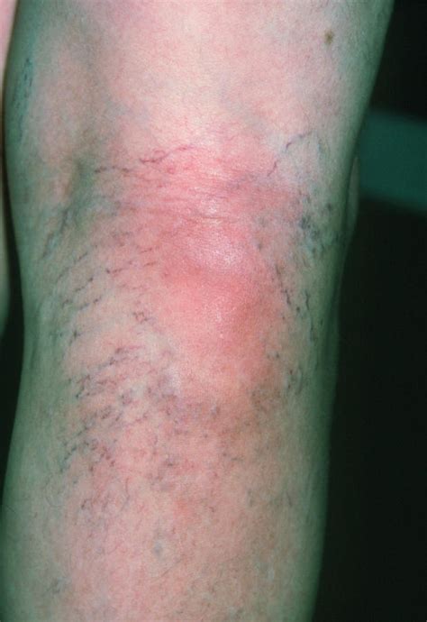 Superficial Thrombophlebitis In 60 Year Old Woman Photograph By Dr P