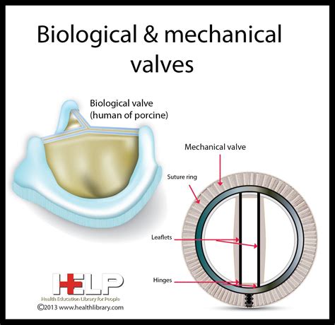 Biological And Mechanical Valves Aortic Valve Replacement Heart
