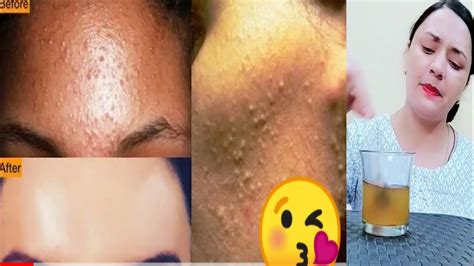 Get Rid Of Tiny Bumps On Face And Forhead Tested And 100 Satisfying