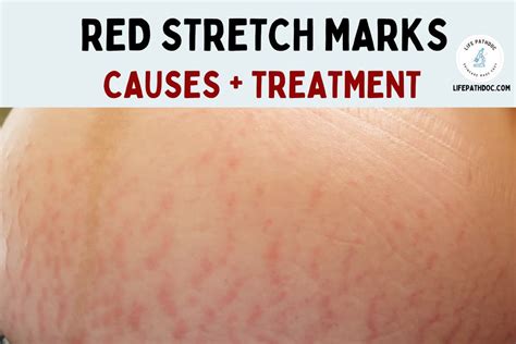 Red Stretch Marks Striae Rubra Causes And How To Treat Them