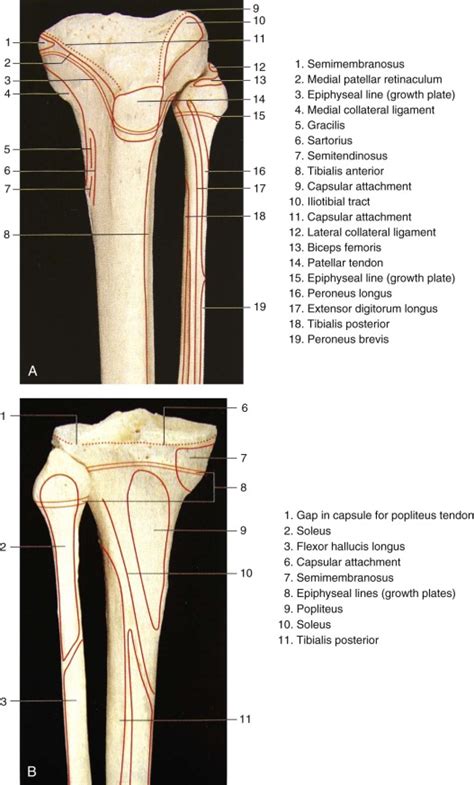 Tibial Plateau Fractures Musculoskeletal Key
