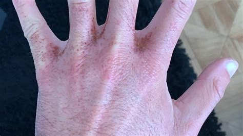 Customers Suffer Burns After Hand Gel Mixed Up With Drain Cleaner