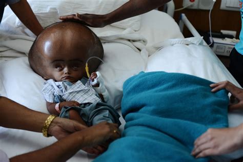 Alien Baby Suffers From A Dangerously Rare Health Condition That