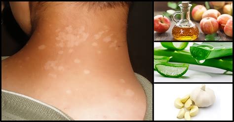 Effective Home Remedies To Treat Tinea Versicolor An An Dr Farrah Md