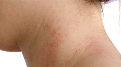 7 Types Of Eczema Causes Symptoms And Treatments Gladskin