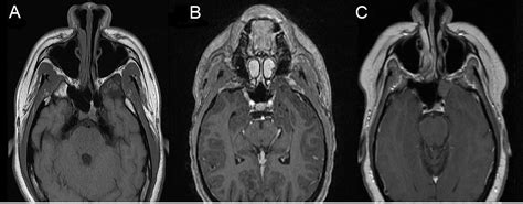 Left Temporal Lobe Epilepsy Due To Large Sphenoidal Encephalocele With