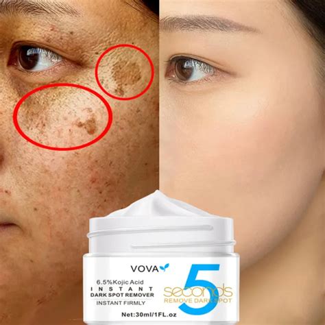 Kojic Acid Dark Spot Corrector Cream Whitening Freckle Cream Powerful