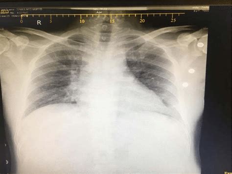Chest X Ray Showed Bronchial Shadows With Reticulonodular Pattern