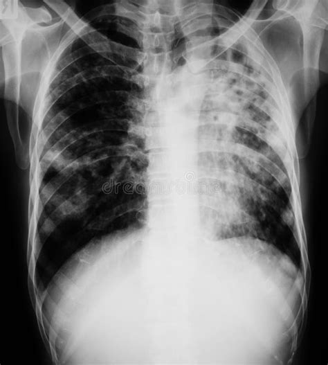 Chest X Ray Image Of Patient With Pulmonary Tuberculosis Stock Photo