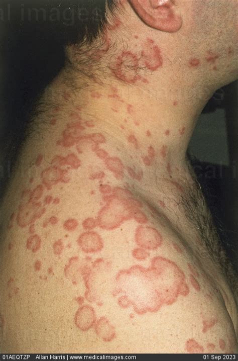 Stock Image Close Up Of Urticaria Hives Showing An Acute Urticarial