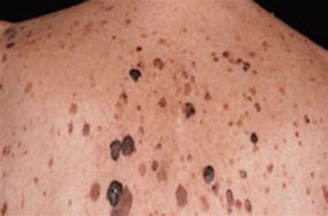 Seborrheic Keratosis