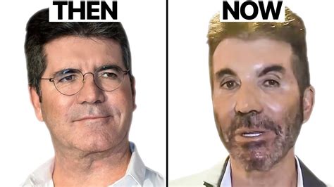 simon cowell new face plastic surgery analysis Клиника лазерной эстетики Перлина
