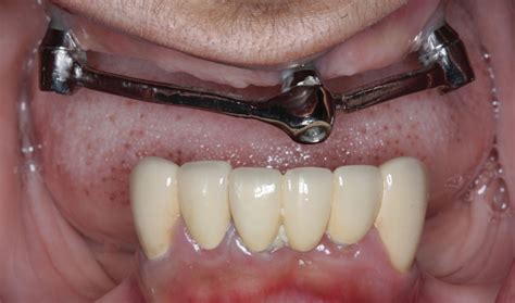 Full Mouth Rehabilitation With Fixed Implant Supported Prostheses