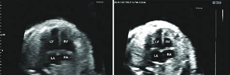 A Fetal Echocardiography Image Of Four Chamber View At High Dynamic