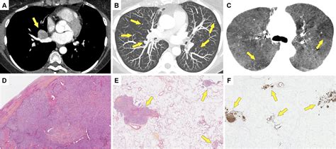Lung Carcinoid Tumors With Diffuse Idiopathic Pulmonary Neuroendocrine