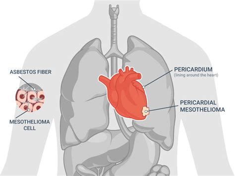 Pericardial Mesothelioma Cancer Life Expectancy And Survival Rate By