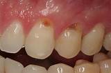 Photos of Gum Line Cavity Treatment
