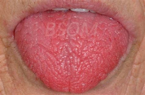 Dry Mouth Sjögrens Syndrome British And Irish Society For Oral Medicine