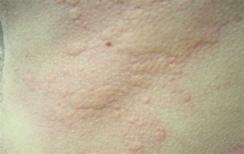 Home Remedies For Hives