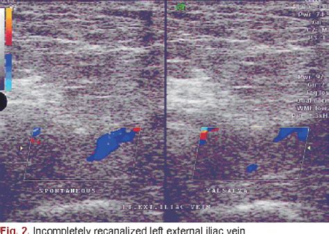 Figure 2 From Recurrent Deep Vein Thrombosis Due To Thrombophilia