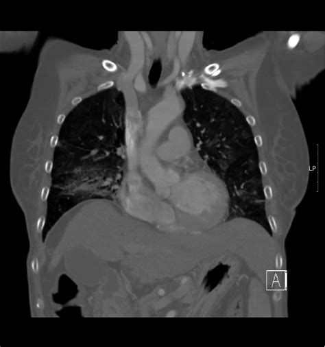 Follow Up Chest Computed Tomography Scan Revealed The Radiation