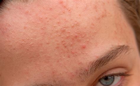 How Can I Get Rid Of Pimples On The Forehead Acne Help Mdacne