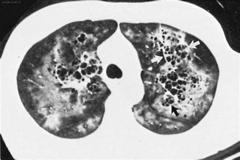 Pneumonia Pneumocystis Jiroveci Diseases And Conditions 5minuteconsult