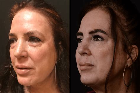 Eye Bags Surgery Lower Blepharoplasty Before And After Photos New