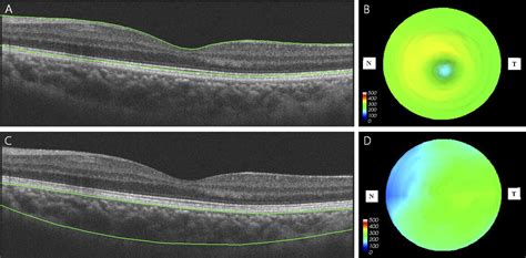 Choroidal Thickness And Volume Mapping By A Six Radial Scan Protocol On