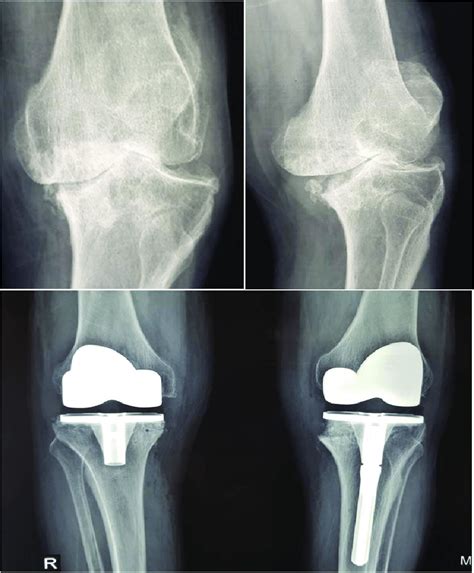 Bilateral Total Knee Arthroplasty Using Bone Graft From Distal Femur