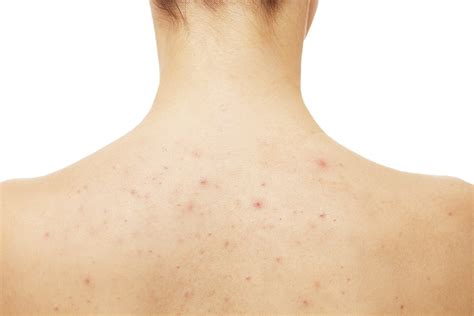 What You Need To Know About Back Acne Short Hills Dermatology